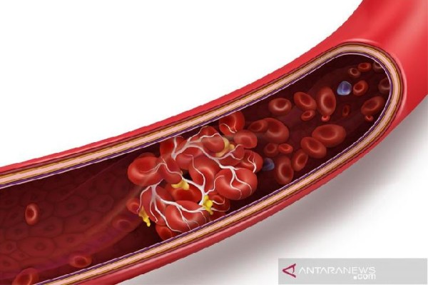Berikut Sejumlah Kebiasaan yang Memicu Pembuluh Darah Pecah