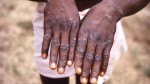 Bagaimana Penularan Cacar Monyet, Apa Gejala Monkeypox?