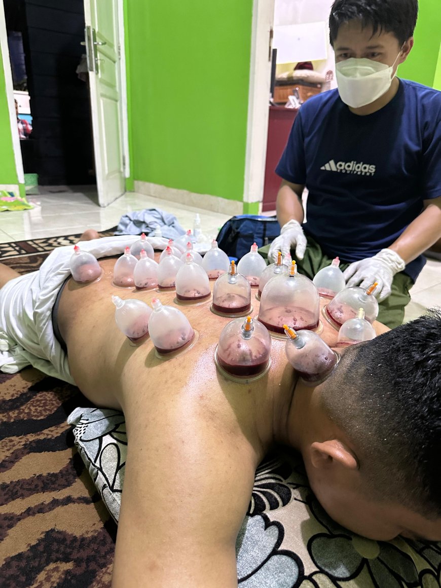 Bekam, Terapi Tradisional Bernilai Medis yang Kian Diminati