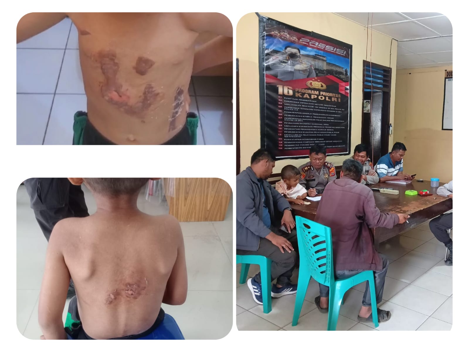 Sadis, Ibu Asal Seribudolok Simalungun Ini Tega Seterika Tubuh Bocah 6 Tahun Sadis, Ibu Asal Seribudolok Simalungun Ini Tega Seterika Tubuh Bocah 6 Tahun