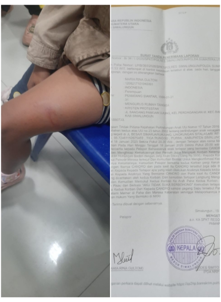 Bagian paha korban tampak memar (kiri), surat tanda terima laporan pengaduan yang dikeluarkan Polres Simalungun.