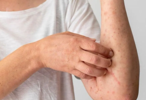 Waspada Lupus! Kenali 4 Gejala Awal Penyakit Autoimun Ini Sebelum Terlambat, Bisa Bikin Gagal Ginjal
