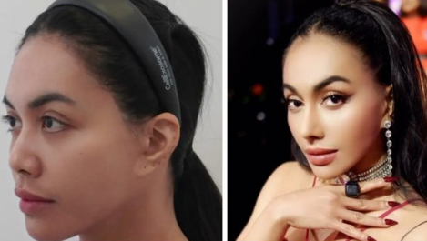 Denada Operasi Plastik Lagi di 2025, Total 3 Kali! Ini Transformasinya yang Bikin Kaget!