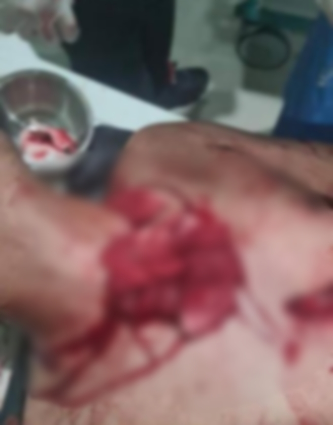 Korban EES saat terbaring mendapat rawatan setelah ditusuk dengan pecahan botol, Sabtu malam (10/6).