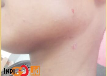 Agus Hutasoit siswa SMAN 1 Pagaran terlihat ada bekas luka cekik dilehernya, Jumat (17/5).