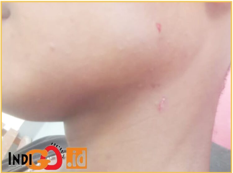 Agus Hutasoit siswa SMAN 1 Pagaran terlihat ada bekas luka cekik dilehernya, Jumat (17/5).