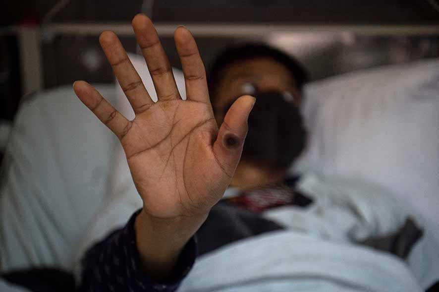 Masyarakat Alami Penurunan Kekebalan dari Virus Cacar