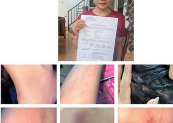 Korban penganiyaan, Pitriani Br Napitupulu menunjukan bukti laporan pengaduannya dan kondisi luka-luka dialaminya