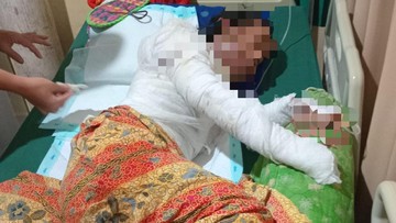 Suami di Lampung Bakar Istri Hamil, Korban Alami Luka Bakar 80 Persen