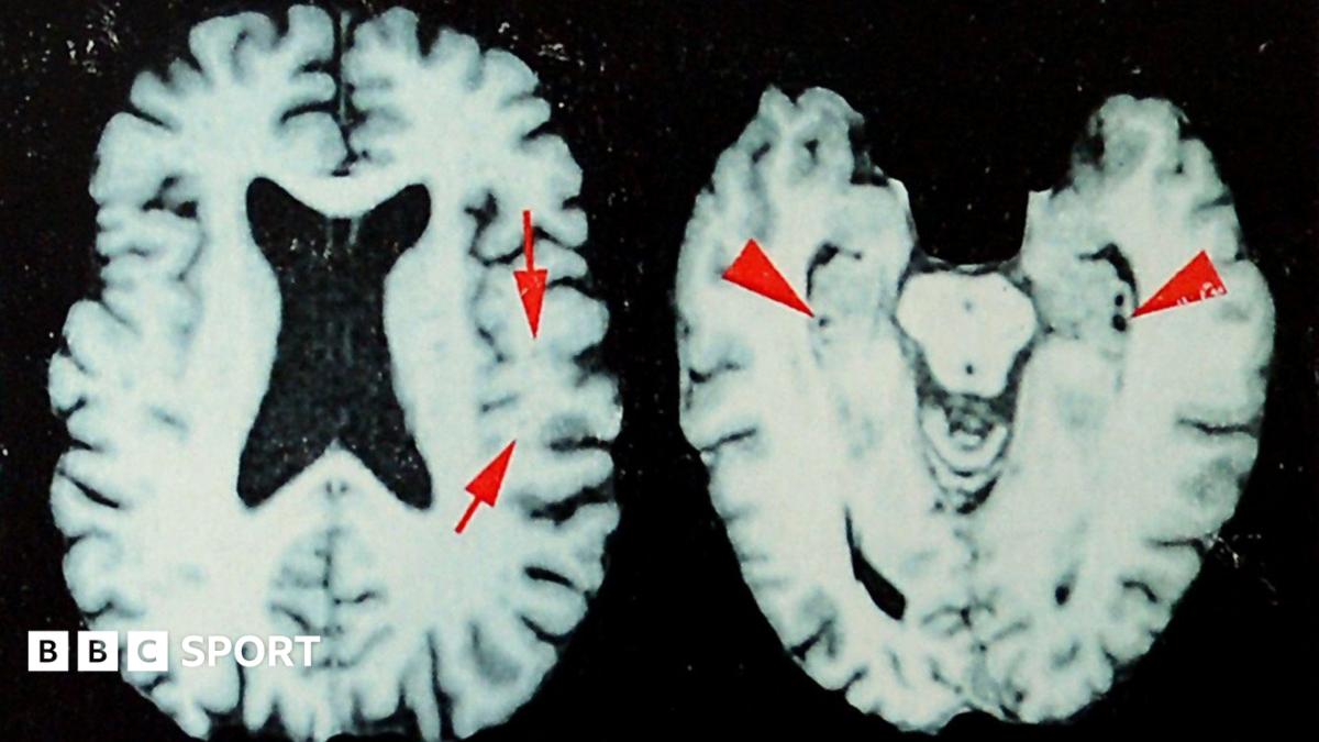 Study Suggests Up to 98% of Deceased NFL Players May Have Had CTE