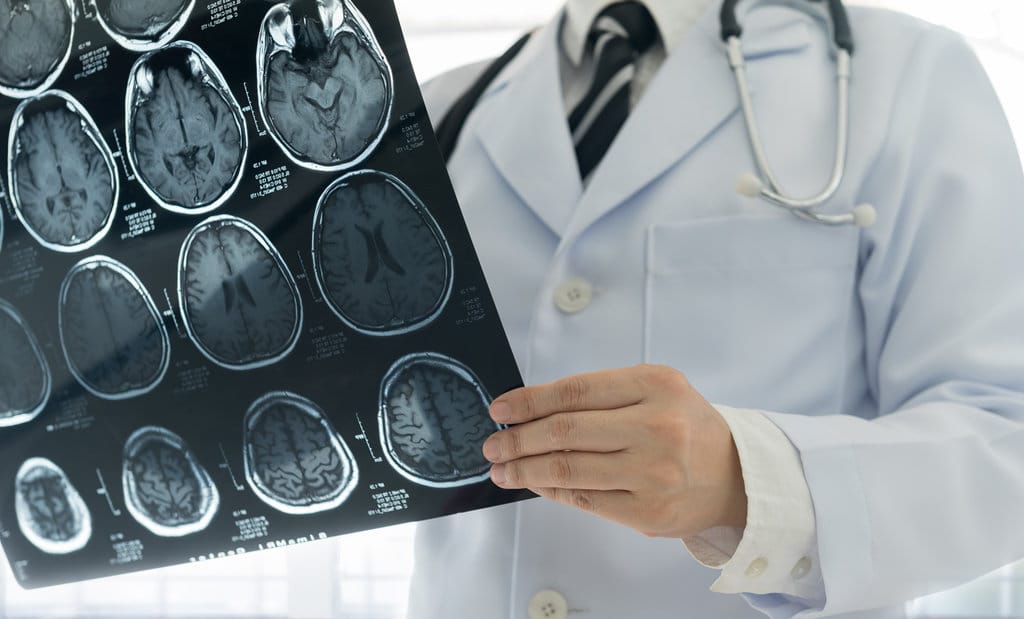 Peringatan Dini: Stroke Kini Mengintai Generasi Muda