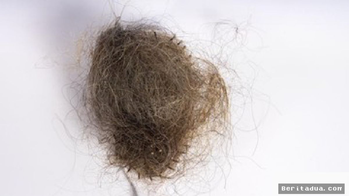 AS — Dokter Angkat Gumpalan Rambut 1,5 Kg dari Perut Remaja