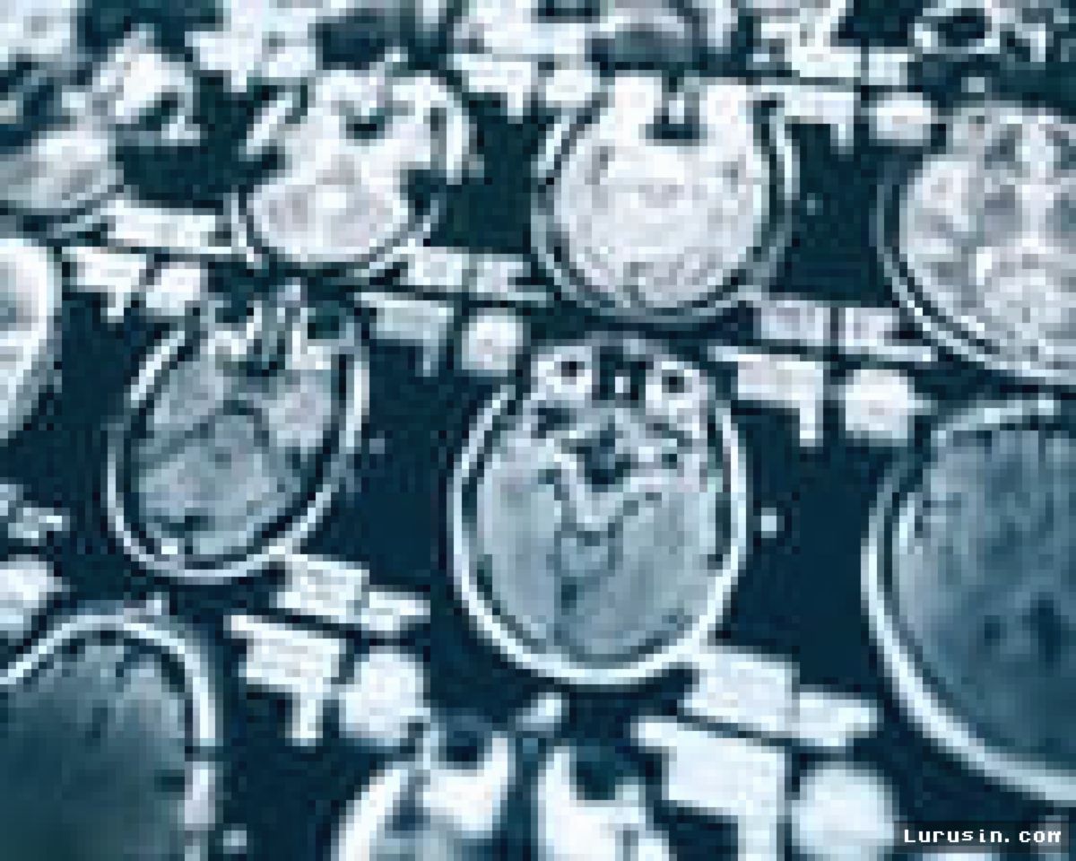 Pemotongan Anggaran Trump Hentikan Riset Alzheimer bagi Ratusan Lansia