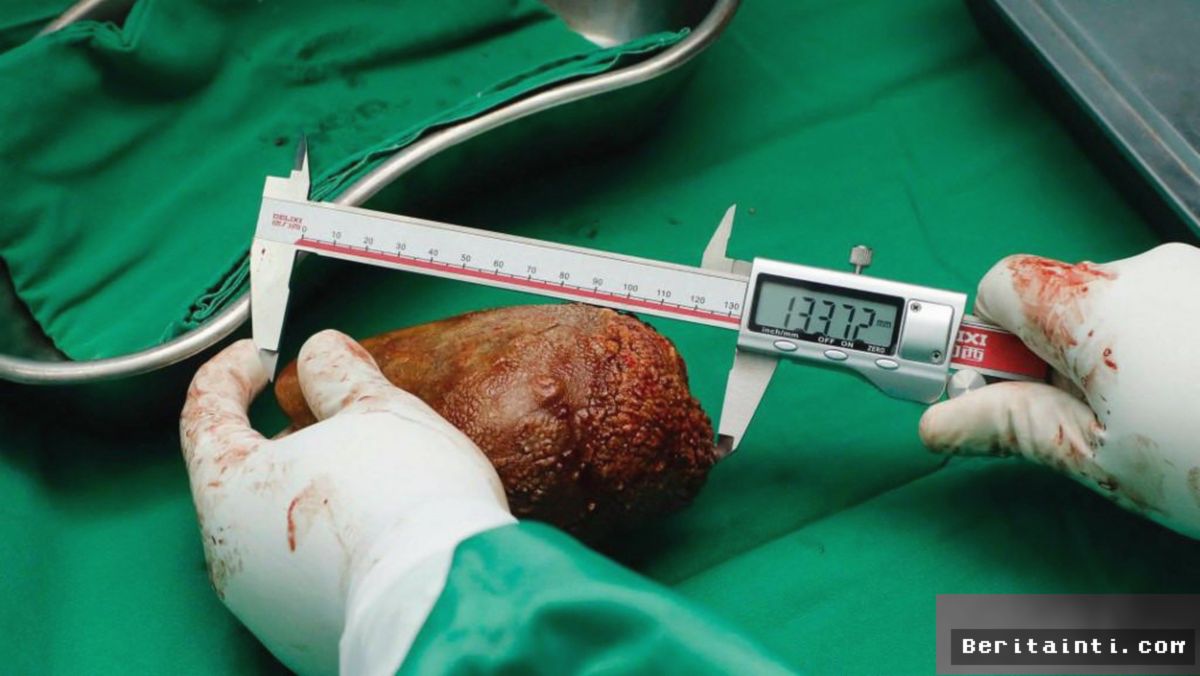 KESEHATAN — Empat Perubahan Urine Menandai Kerusakan Ginjal Dini