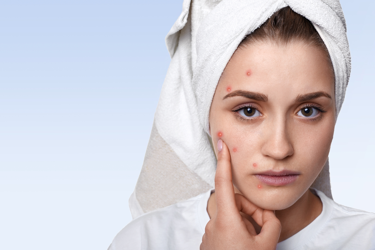 Rajin Gunakan Skincare Tapi Jerawatan di Usia Dewasa? 5 Hal Ini Mungkin Jadi Sumber Masalahnya!
