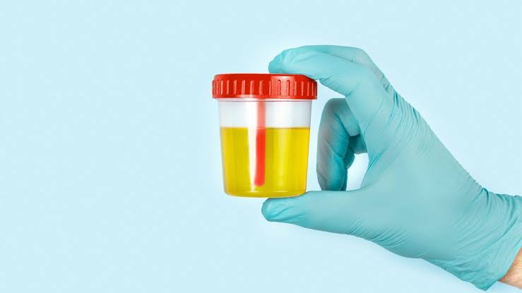Tes Urine Bisa Deteksi Kanker Prostat di Awal? Ini Hasil Studinya!