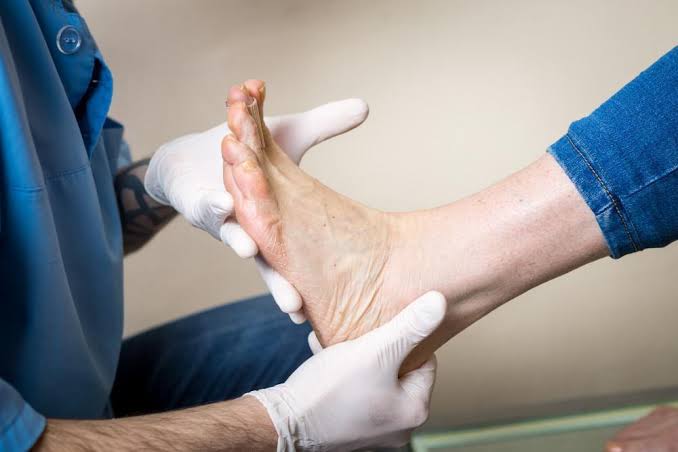 Waspada! Ini Bahaya Diabetes yang Diam-Diam Bisa Bikin Kaki Harus Diamputasi 