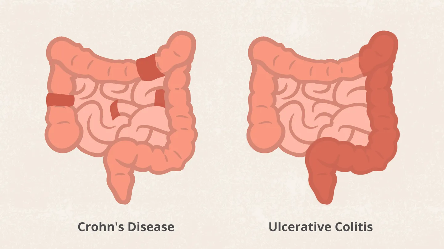 Penyakit Usus Crohn’s vs Ulcerative Colitis, Bedanya Apa Sih? 