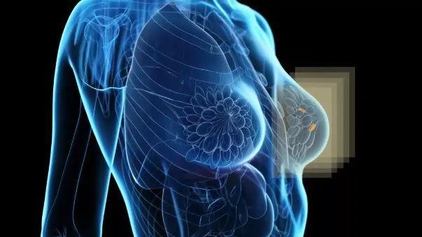 Harus Waspada! Ini Fakta Lengkap soal Kanker Payudara yang Wajib Kamu Tahu