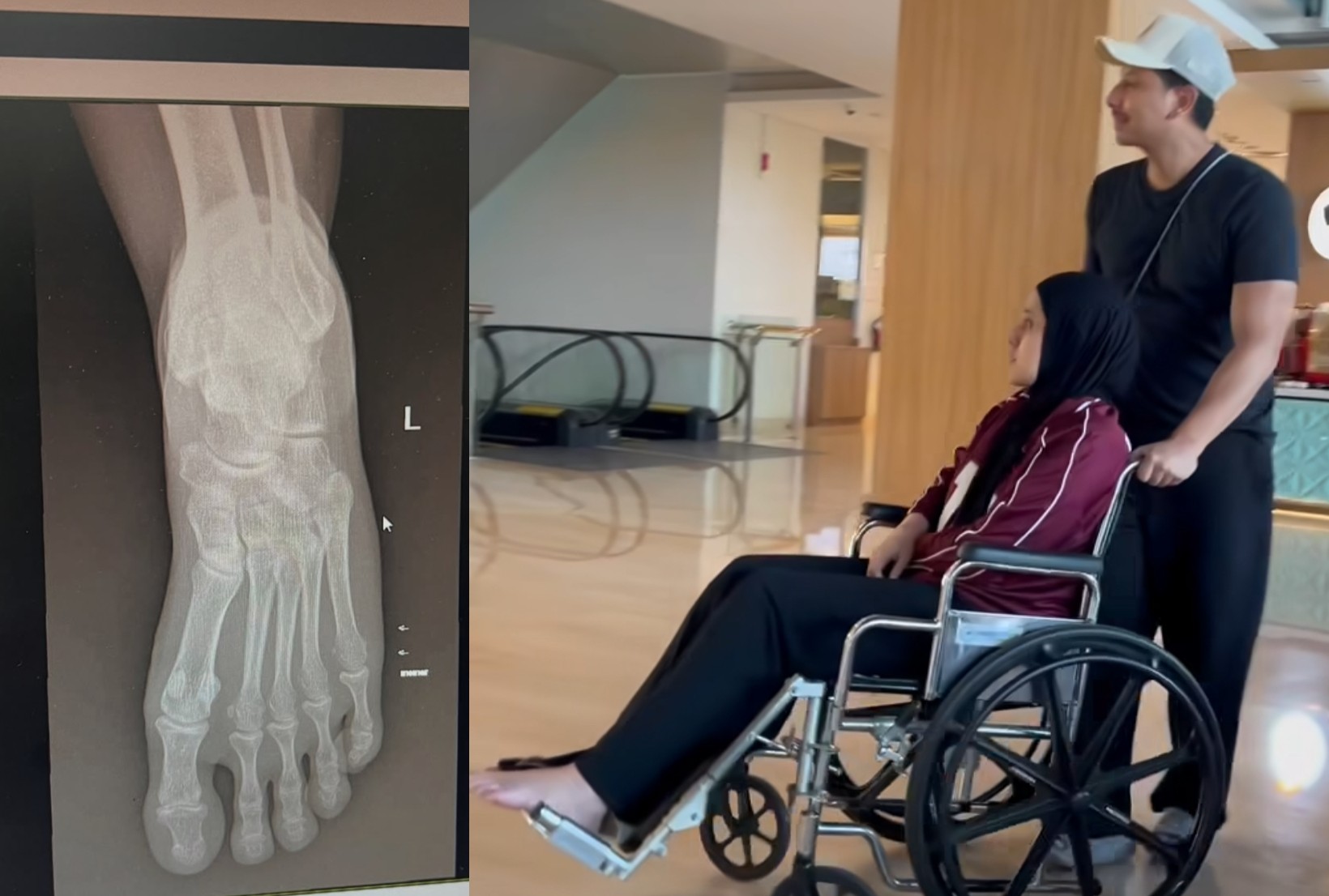 Gara-Gara Diinjak 'Kahfi' yang Beratnya Lebih dari 1 Ton, Kaki Fairuz A Rafiq Alami Memar dan Bengkak!