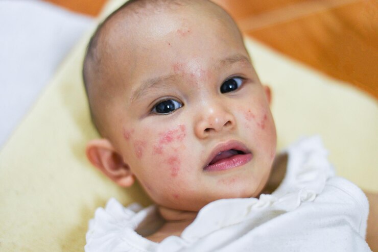 Jangan Anggap Remeh! Ini 6 Penyakit Berbahaya yang Bisa Menular Pada Anak Kecil Lewat Ciuman dan Sentuhan gbr