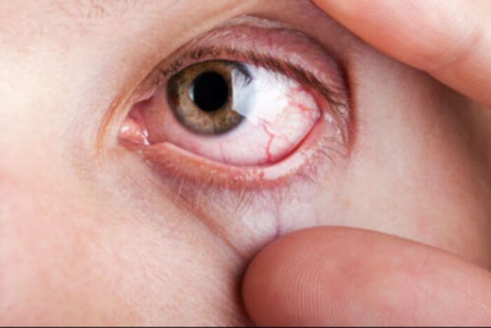 Diabetes Bisa Bikin Buta Di...