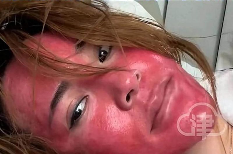 Ngeri! 22 Tahun Tak Bersihkan Makeup, Wajah Wanita Ini Melepuh dan Rusak Parah, Jangan Ditiru!