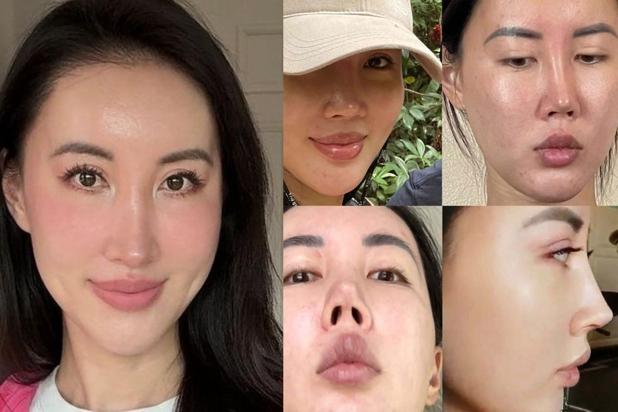 Viral! Bosan dengan Wajah Sendiri, TikToker Ini Jalani 5 Kali Operasi Hidung hingga Habis Rp 1,9 Miliar!