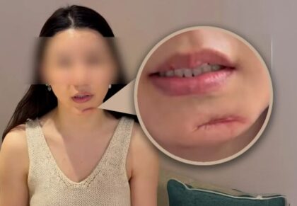 Tragis! Ingin Cantik Lewat Operasi Plastik di Korea, Wajah Wanita Ini Malah Rusak Permanen dan Berakhir Depresi!