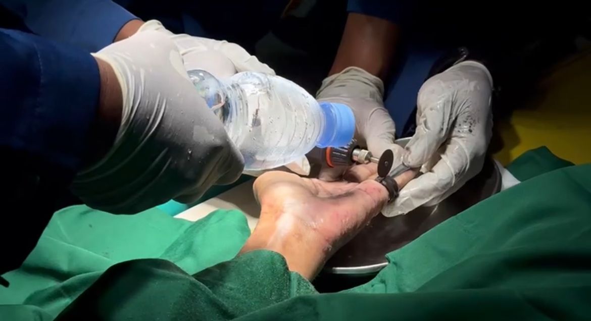 Jari Membengkak, Cincin Besi di Tangan ODGJ Dipotong di RSUD Trenggalek