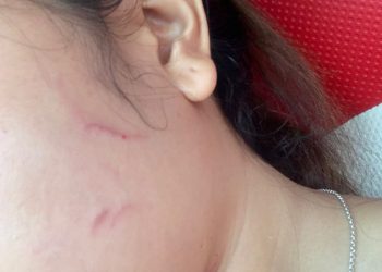 Korban memperlihatkan luka lebam setelah dikeroyok