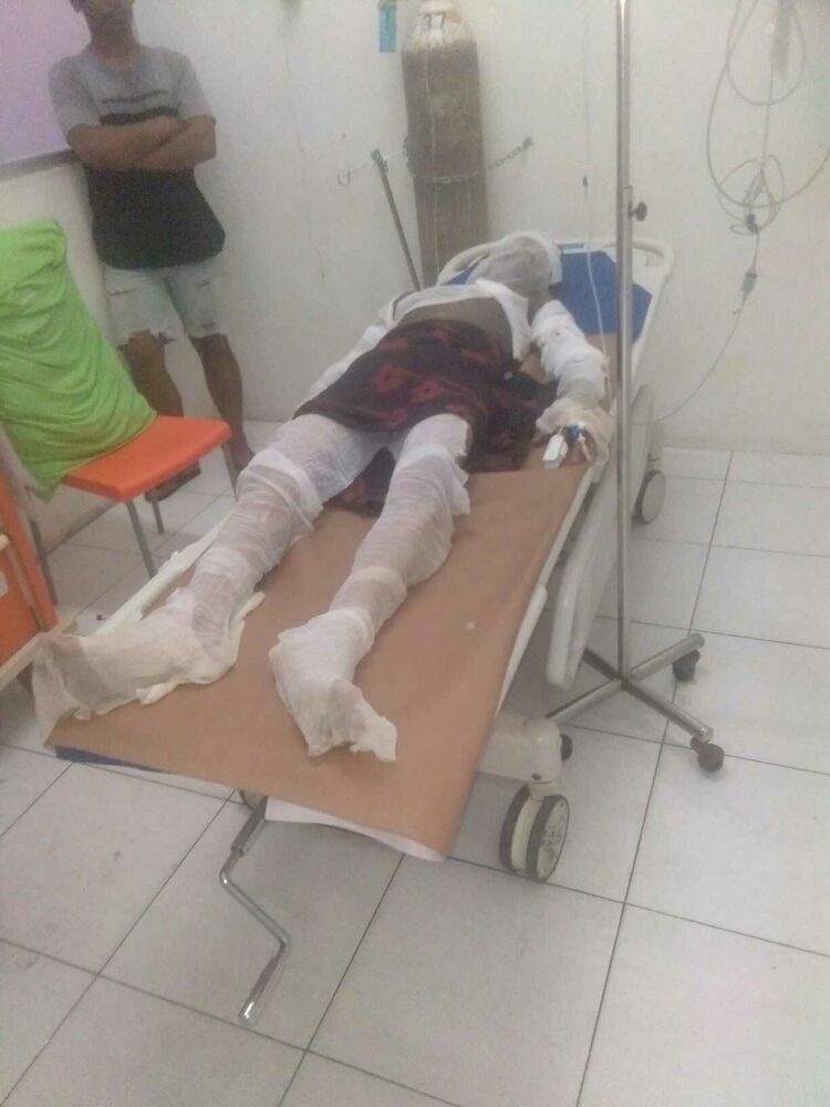 DIBAKAR: Deni saat pertama kali mendapat perawatan medis di RS Muhammadiyah akibat tubuhnya gosong akibat dibakar 2 pria, Rabu (25/10/2023).(Foto Dok/Keluarga Korban)