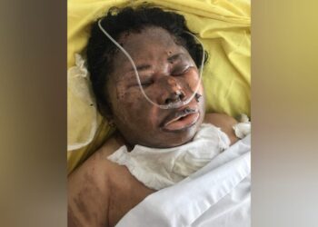 SEKARAT: Herlinda br Gurusinga sekarat dan harus dirawat intensif di RS Haji setelah dibakar hidup-hidup oleh SP alias Leman.(Foto Dok/Febri)