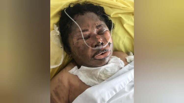 SEKARAT: Herlinda br Gurusinga sekarat dan harus dirawat intensif di RS Haji setelah dibakar hidup-hidup oleh SP alias Leman.(Foto Dok/Febri)