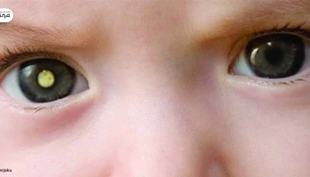 Retinoblastoma: Bahaya yang Mengintai di Balik Cahaya Mata