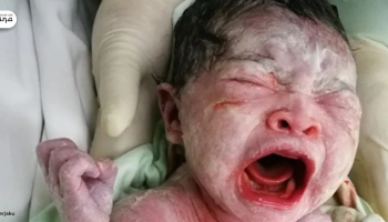Vernix Caseosa: Lapisan Putih pada Bayi yang Penuh Manfaat