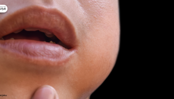 Waspada Parotitis: Penyakit Gondongan yang Sering Disepelekan!
