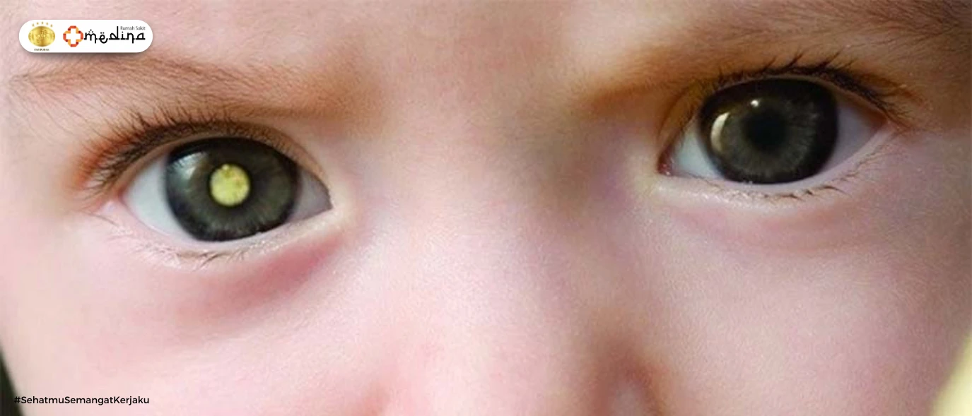 artikel kesehatan Retinoblastoma: Bahaya yang Mengintai di Balik Cahaya Mata