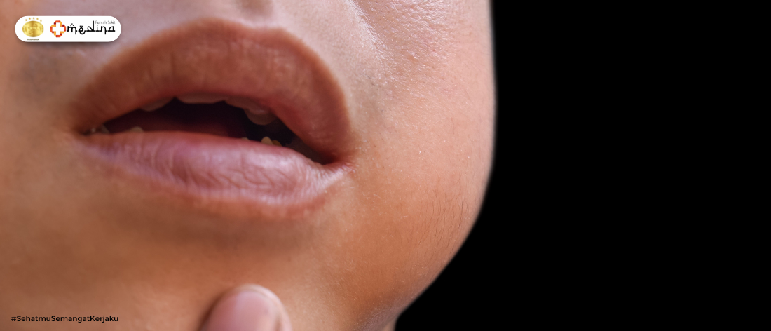 artikel kesehatan Waspada Parotitis: Penyakit Gondongan yang Sering Disepelekan!