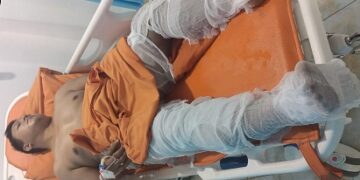 Korban yang mengalami luka bakar