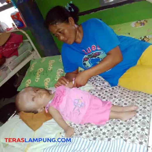 Balita Penderita Hydrocephalus asal Lampura Dirujuk ke RSU Abdoel Moeloek