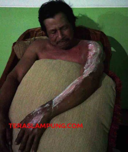 Selamatkan Nyawa Istri, Pria Ini Rela Tangannya Dijilat Api