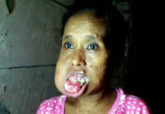 Tasrini Butuh Bantuan Para Dermawan, Ansor Way Kanan Galang Dana