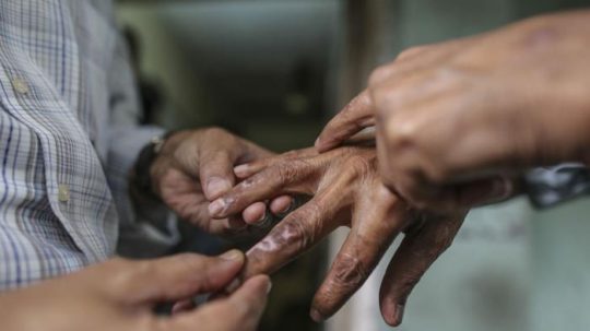 Dinkes Lampura Temukan Delapan Kasus Penyakit Kusta