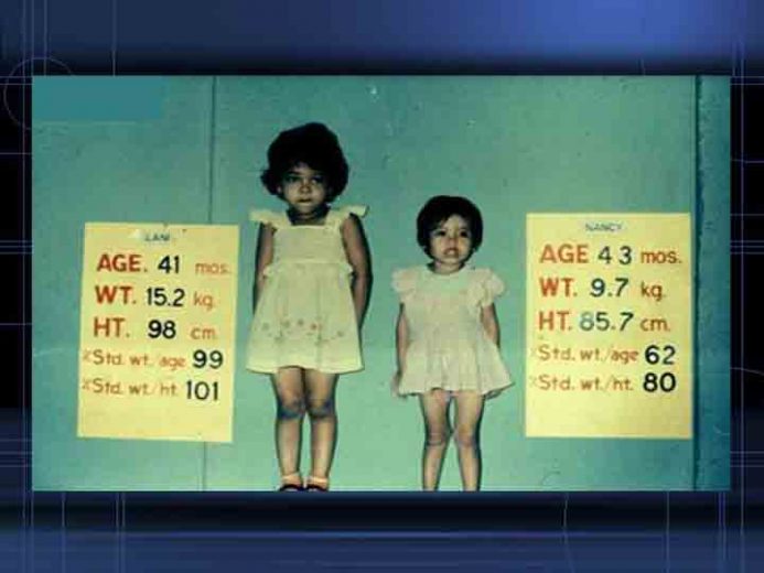 Yang Perlu Anda Ketahui tentang Balita Gagal Tumbuh atau “Stunting”