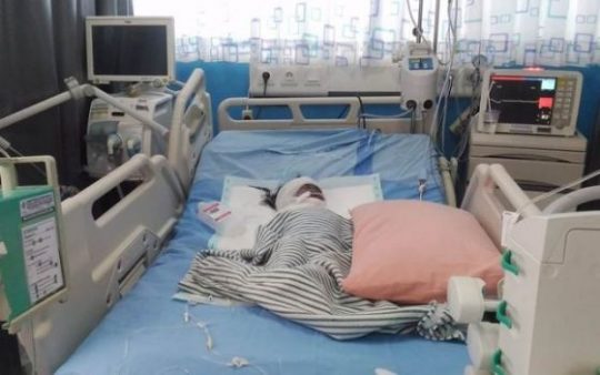 Masuk Kuali Isi Rebusan Gula, Tubuh Balita asal Lamsel Ini Melepuh