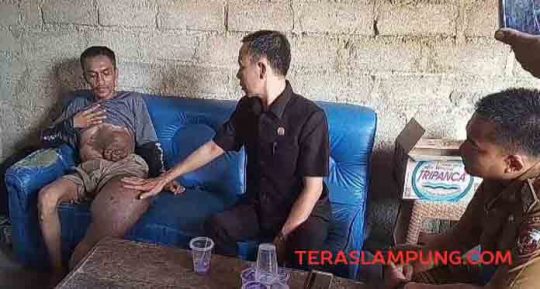 Rumahnya Hanya 3 Km dari Pemkab Lampung Utara, Penderita Kaki Gajah Ini tak Pernah Dapat Bantuan