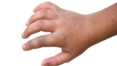 Tangan Bocah Ini Bengkak karena Terinjak Kaki Ibu-ibu yang Heboh Joget untuk Dapatkan Uang Saweran