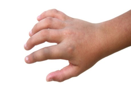 Tangan Bocah Ini Bengkak karena Terinjak Kaki Ibu-ibu yang Heboh Joget untuk Dapatkan Uang Saweran