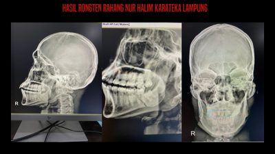Barbarisme di Arena Kareta PON Papua, Tulang Rahang Karateka Lampung Cidera Sangat Serius